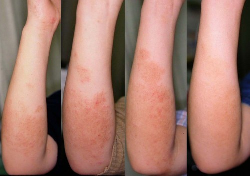 Common dry skin conditions and their causes - WebMD Boots